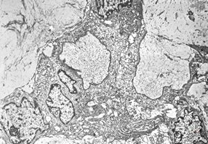 F,22y. | Pindborg tumor